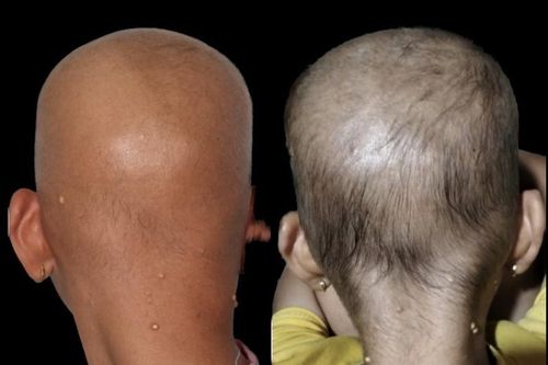 Căn bệnh hiếm khiến bé gái nổi hạt kê, trọc đầu nhiều năm