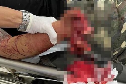 Một thanh niên bị pháo nổ dập nát cụt bàn tay