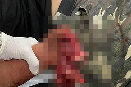 Nam thanh niên dập nát bàn tay vì nghịch pháo tự chế