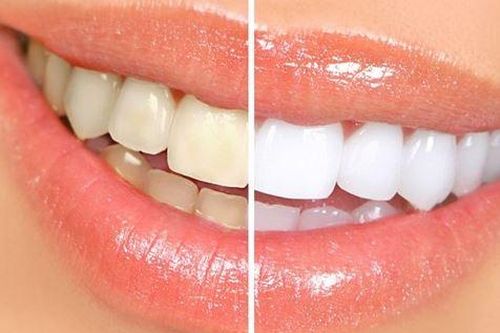 Răng bạn có vàng ố tới mấy cũng trắng ngay lập tức khi dùng chanh cách này