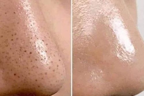 Mụn đầu đen, trị thế nào?