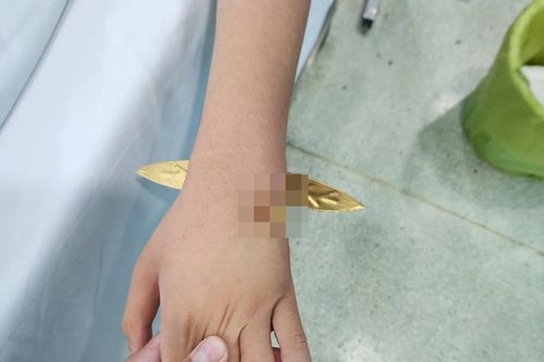 Bị thanh kim loại đâm xuyên thấu cổ tay do ngã khi đi thăm mộ cận Tết