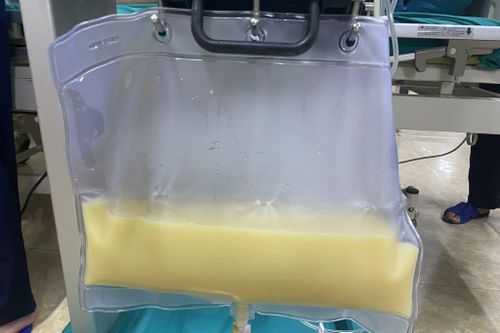 Phát hiện máu đục như sữa khi nhập viện vì đau bụng