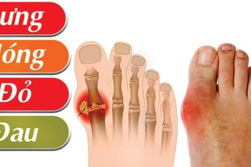 Người bệnh gout ăn gì ngày Tết để tránh cơn đau bùng phát?