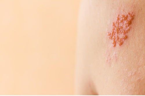 Số người khám các bệnh lý về da gia tăng