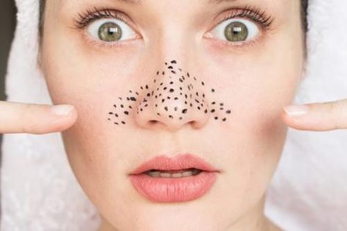 4 cách đơn giản giúp loại bỏ mụn đầu đen ở mũi