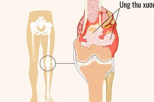 Ung thư xương: Bác sĩ cảnh báo những dấu hiệu cần lưu ý