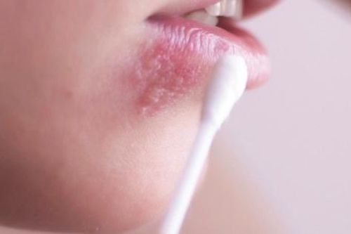 Bệnh herpes môi có tự khỏi không, làm gì để tránh tái phát?