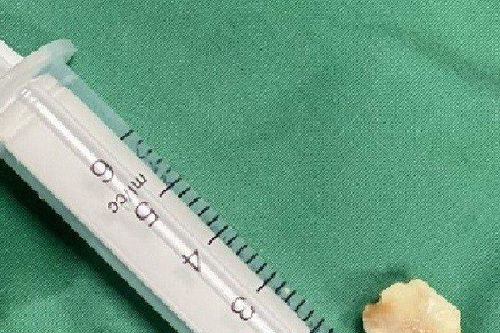 Bị ho suốt 20 ngày, đi khám mới biết có hạt lạc trong phế quản