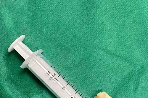 Hạt lạc nằm trong phế quản người phụ nữ hơn 20 ngày