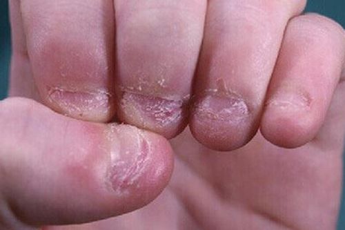 Cần làm gì khi trẻ bị nấm móng?