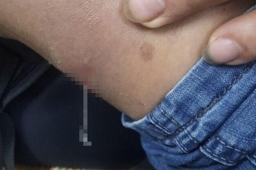 Giun dài 7cm chui ra qua da người đàn ông
