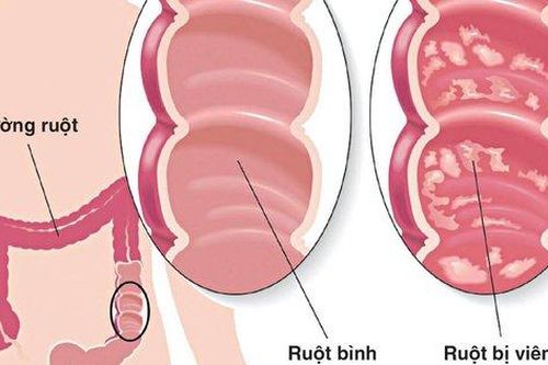 Các chất dinh dưỡng người viêm loét đại tràng hay thiếu hụt và cách bổ sung