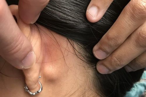 Nổi hạch cổ, khi nào đáng lo?