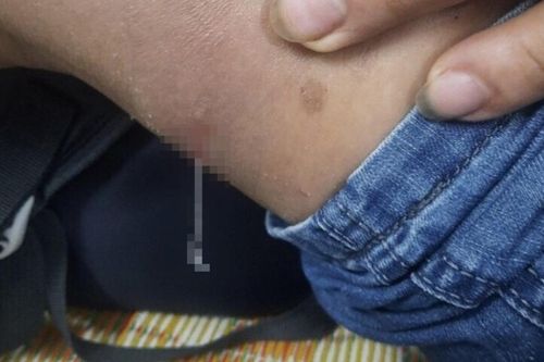 Liên tục gãi khi thấy ngứa vùng cổ, người đàn ông kinh hãi lôi ra một thứ như trong phim kinh dị