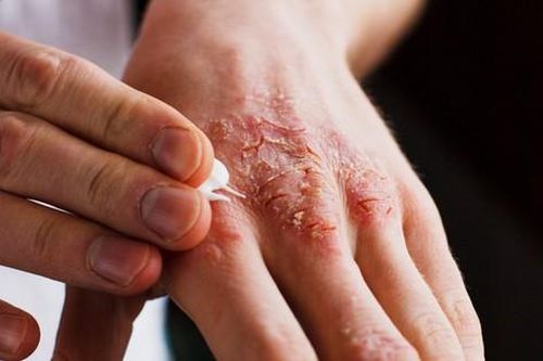 Viêm da tiếp xúc, nguyên nhân và thuốc điều trị