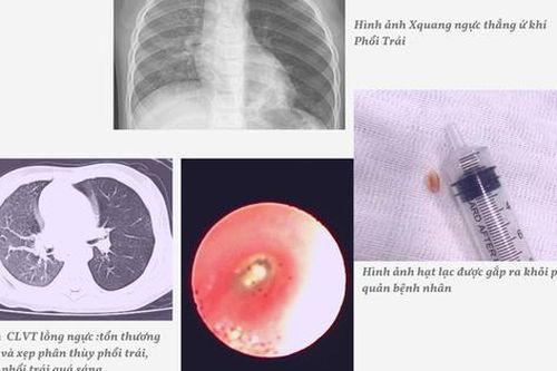 Nghệ An: Cứu sống trẻ mắc dị vật đường thở