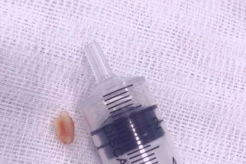 Hạt lạc mắc kẹt gần một tháng trong khí quản cháu bé 18 tháng tuổi