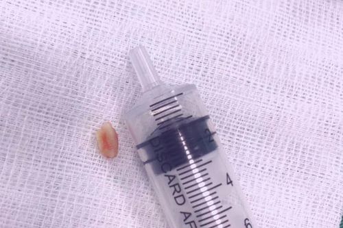 Nghệ An: Cứu sống trẻ 18 tháng tuổi ăn hạt lạc bị mắc trong khí quản
