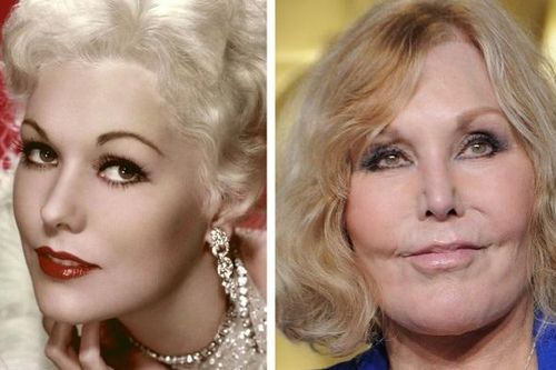 Những mỹ nhân Hollywood chịu di chứng nặng nề vì phẫu thuật thẩm mỹ