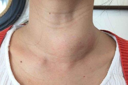 Bướu cổ: Triệu chứng, chẩn đoán và cách điều trị