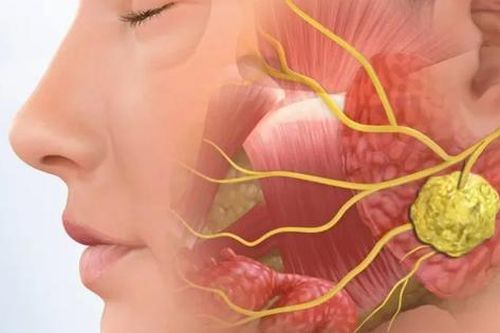 Quản lý bệnh phổi ở người mắc hội chứng Sjögren
