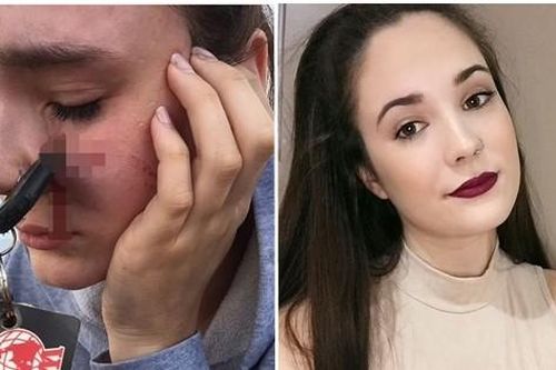 Cô gái bị chìa khóa ô tô ghim vào mặt chỉ vì bắt trượt chùm chìa khóa bạn ném cho