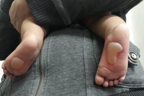 Xót xa bé 8 tháng bị bỏng da phồng rộp đau đớn do đắp tỏi chữa bệnh