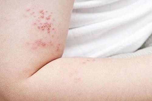 Coi chừng những biến chứng nguy hiểm của zona thần kinh