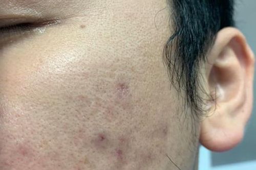 Nam thanh niên ở Hà Nội có hàng chục nốt sẩn trên má sau tiêm meso căng sáng da