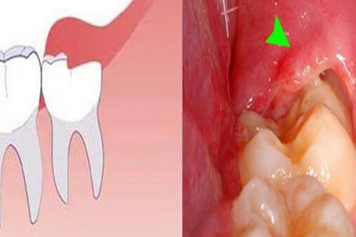 Nhận biết và xử trí răng khôn mọc lệch