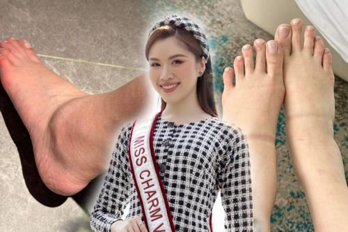 Fan xót xa cho đôi chân sưng húp của Thanh Thanh Huyền: Tất cả vì chiếc sash ở trên vai