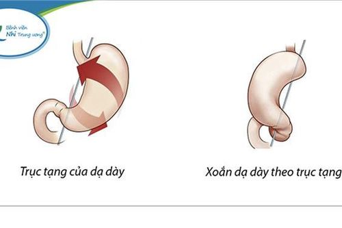 Tưởng con đau bụng do rối loạn tiêu hóa, không ngờ mắc bệnh xoắn dạ dày rất hiếm gặp
