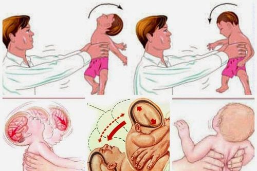 Bệnh nhi 4 tháng tuổi bị chảy máu não nghi do rung lắc, bác sĩ khuyến cáo đặc biệt