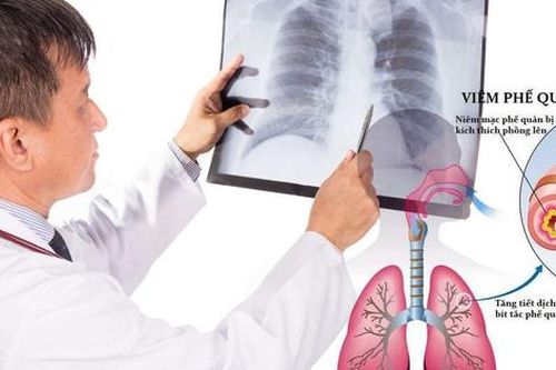Viêm phế quản cấp ở người lớn có biểu hiện như thế nào?