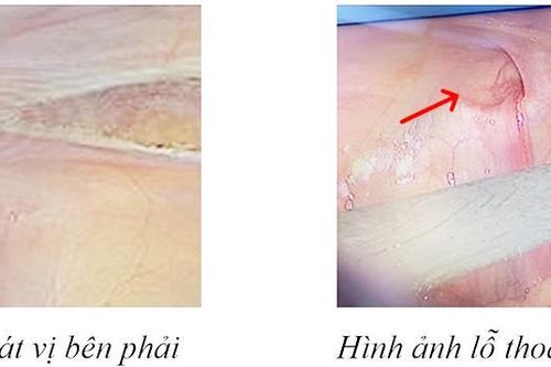 Thoát vị bẹn ở nữ: Gây biến chứng cao, liên quan đến bất thường giới tính