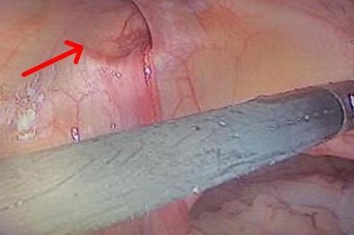 Thoát vị bẹn hai bên có thể gây biến chứng đe dọa tính mạng
