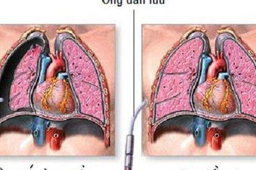 Đau ngực đột ngột, khó thở... cảnh giác với tràn khí màng phổi