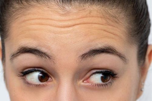 Cách giúp bạn loại bỏ nếp nhăn trên trán
