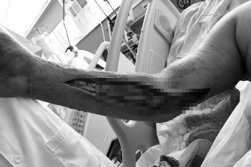 Căn bệnh khiến chàng trai 25 tuổi phải đoạn chi để giữ mạng sống
