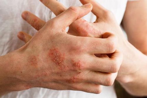 Phòng và điều trị chứng sẩn ngứa da khi trời lạnh