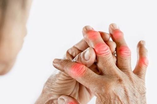 Pháp – Việt phối hợp tìm giải pháp trị dứt điểm bệnh gút