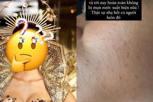 Một hoa hậu suýt hỏng da bởi sử dụng kem có corticoid
