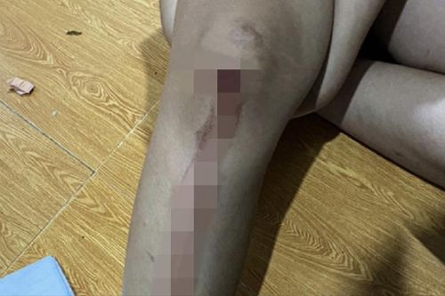2 chị em bất ngờ bị kẻ lạ mặt chĩa súng bắn gây thương tích