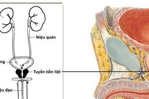 Nguyên nhân dẫn đến nguy cơ gây ung thư tuyến tiền liệt