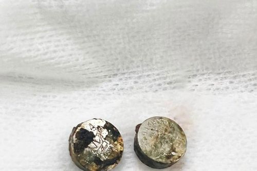 Lấy 2 cục pin cháy khét trong hai lỗ mũi bé gái 6 tuổi