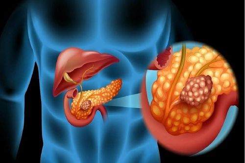 Căn bệnh ung thư tiên lượng xấu, dấu hiệu không rõ ràng