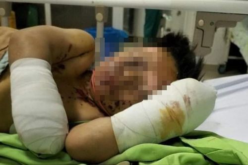 Sau tiếng nổ lớn, bé trai cụt cả hai tay