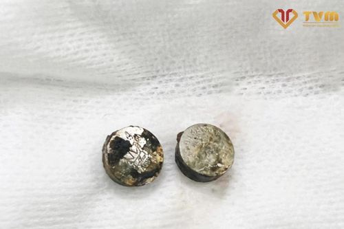 Lấy hai cục pin bị cháy khét trong mũi của bé gái 6 tuổi