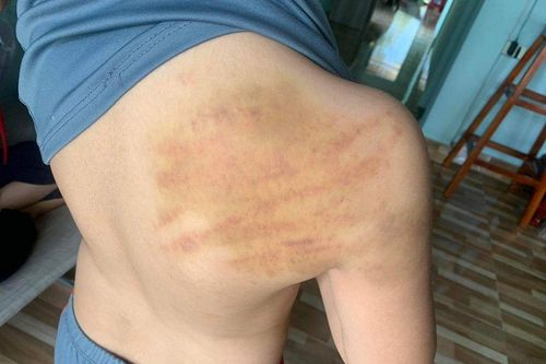 Cập nhật thông tin vụ học sinh lớp 5 bị người dạy thêm tại nhà đánh bầm tím lưng